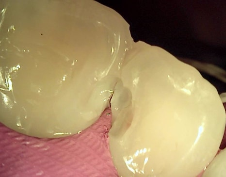 서초동치과 전라도 광주에서 레진 재치료 받으러 오신 사례 관련 이미지 8