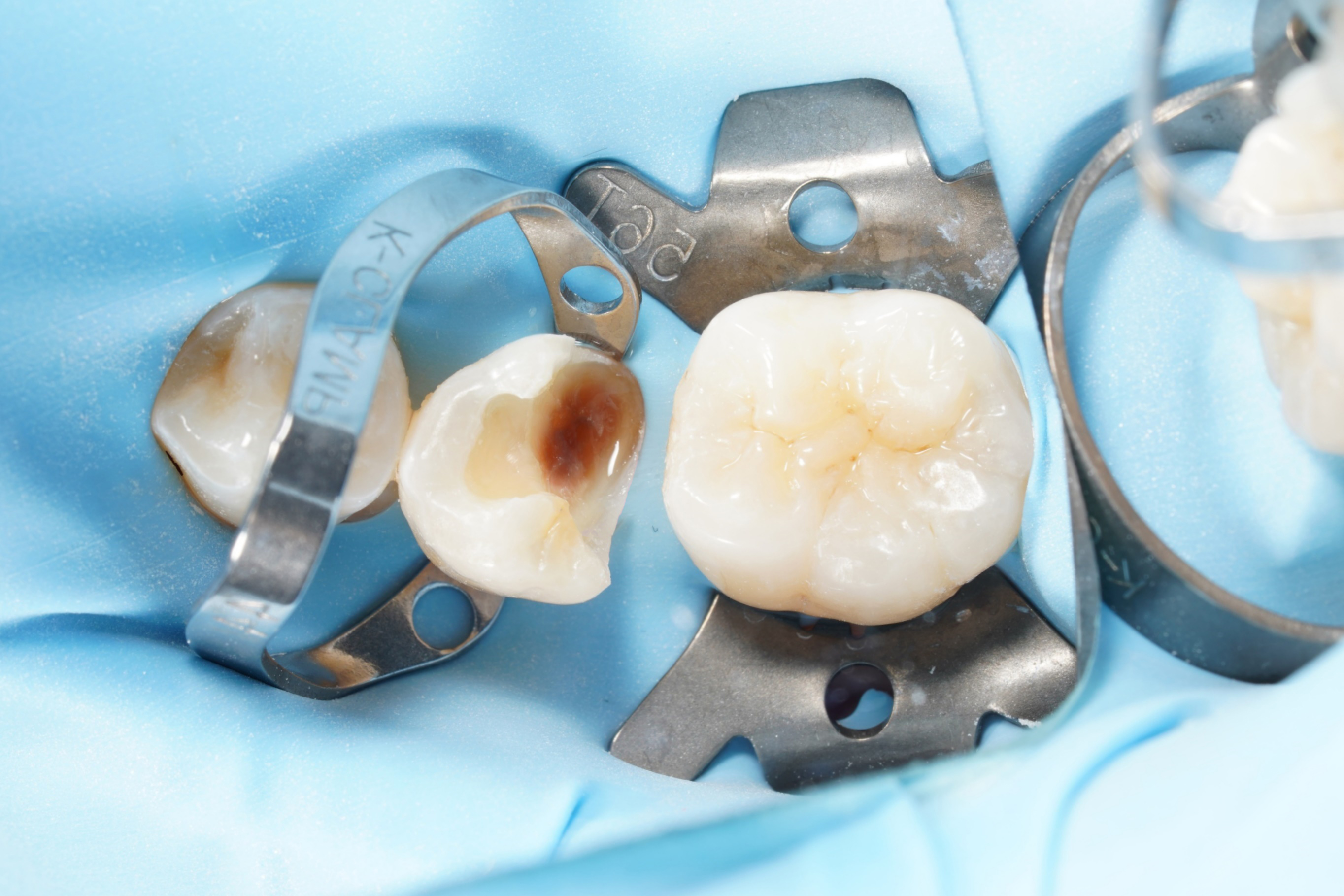 교대역 충치, 신경치료 회피하는 레진빌드업 치과이야기 관련 이미지 1