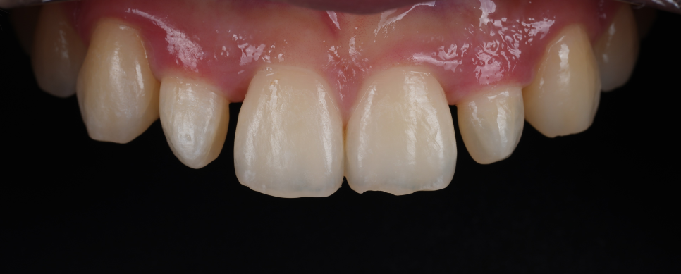 왜소치 라미네이트보다 레진 비니어를 더 추천드리는 이유 관련 이미지 10