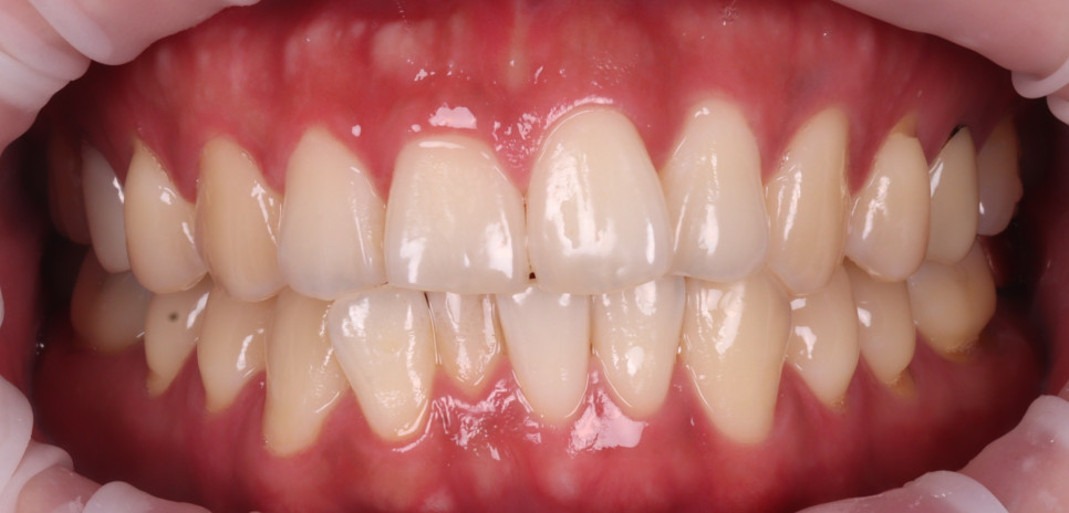 Do Cavities Between Teeth at Sinsa Station Dental Clinic Have to Be Treated with an Inlay? Resin Is Also an Option image 1
