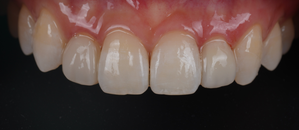 왜소치레진 20년 전에 했던 치아 재치료 후 반대쪽까지 관련 이미지 15