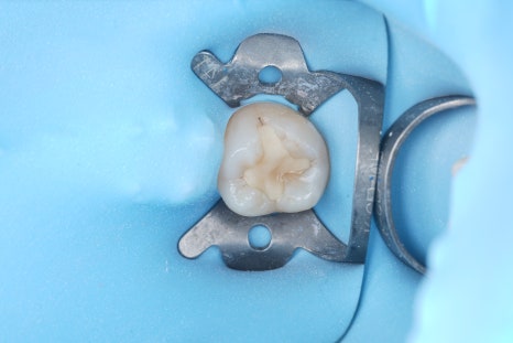 교대역치과 타치과 신경치료, 크라운 진단받았으나 레진으로 치료 관련 이미지 15
