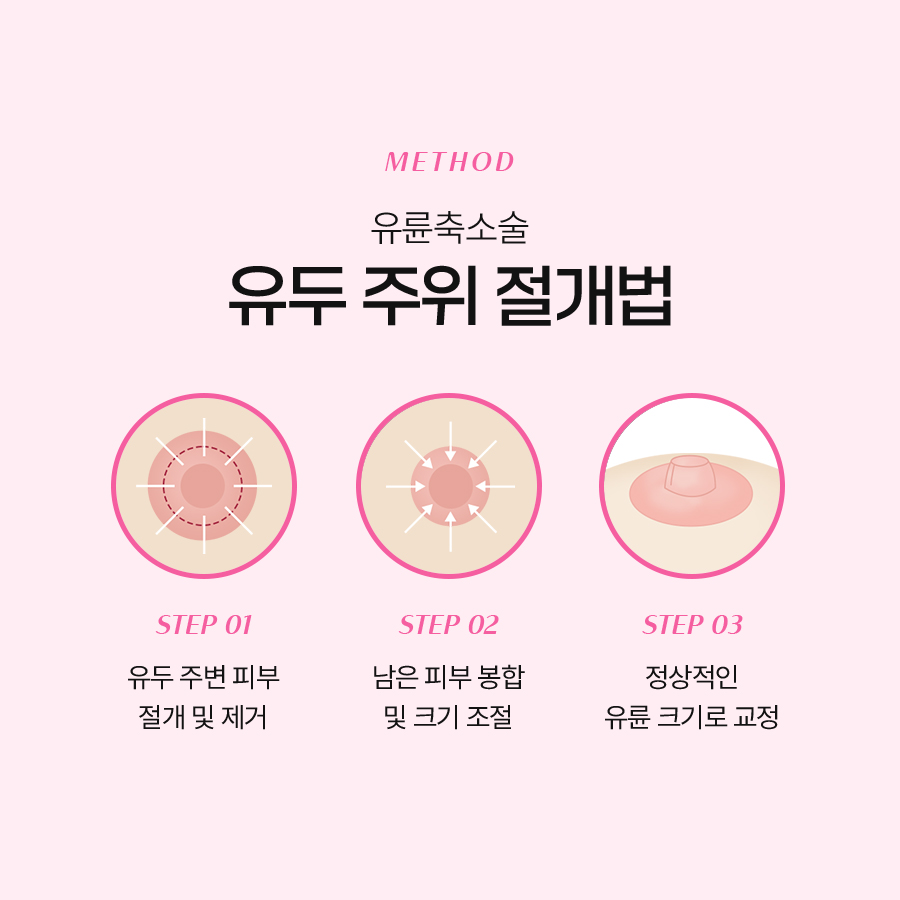 유륜축소수술방법 변화가 시작되는 기준은 무엇일까 관련 이미지 4