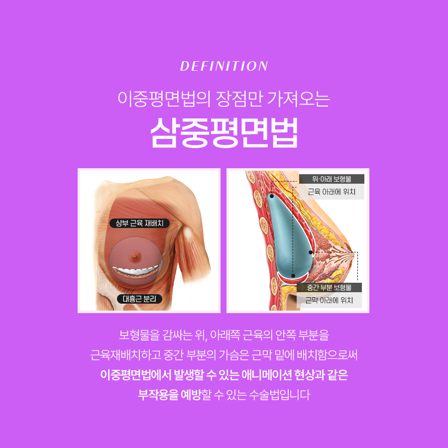 모티바가슴성형수술, 왜 많은 분들이 선택할까? 관련 이미지 3