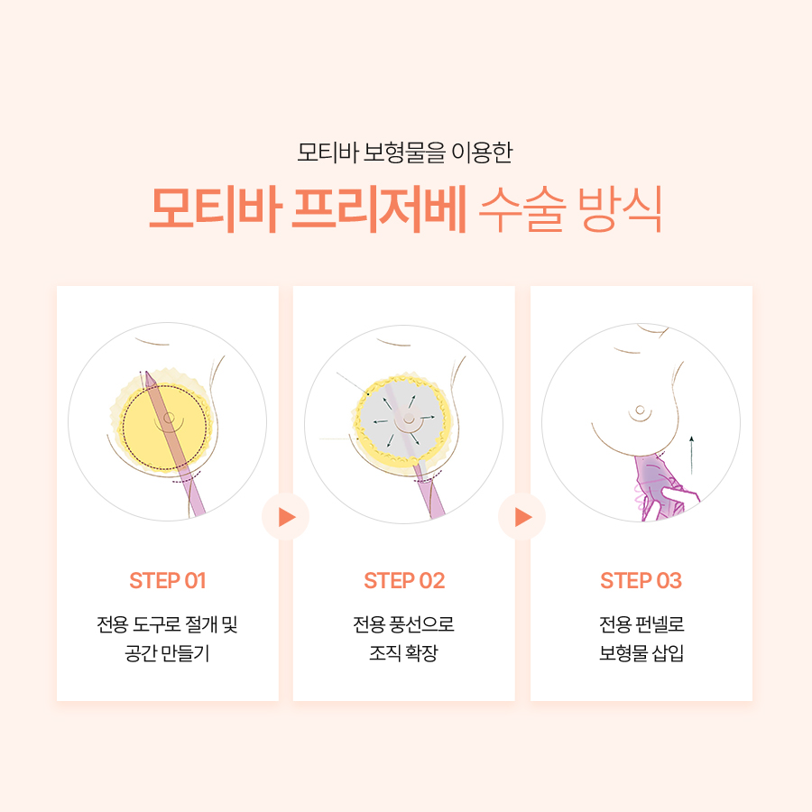 모티바 프리저베 가슴성형, 조직 보존을 고려한 수술 방법 관련 이미지 4