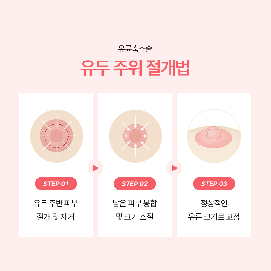 유륜크기교정 유관 보존과 감각 유지의 중요성 관련 이미지 4