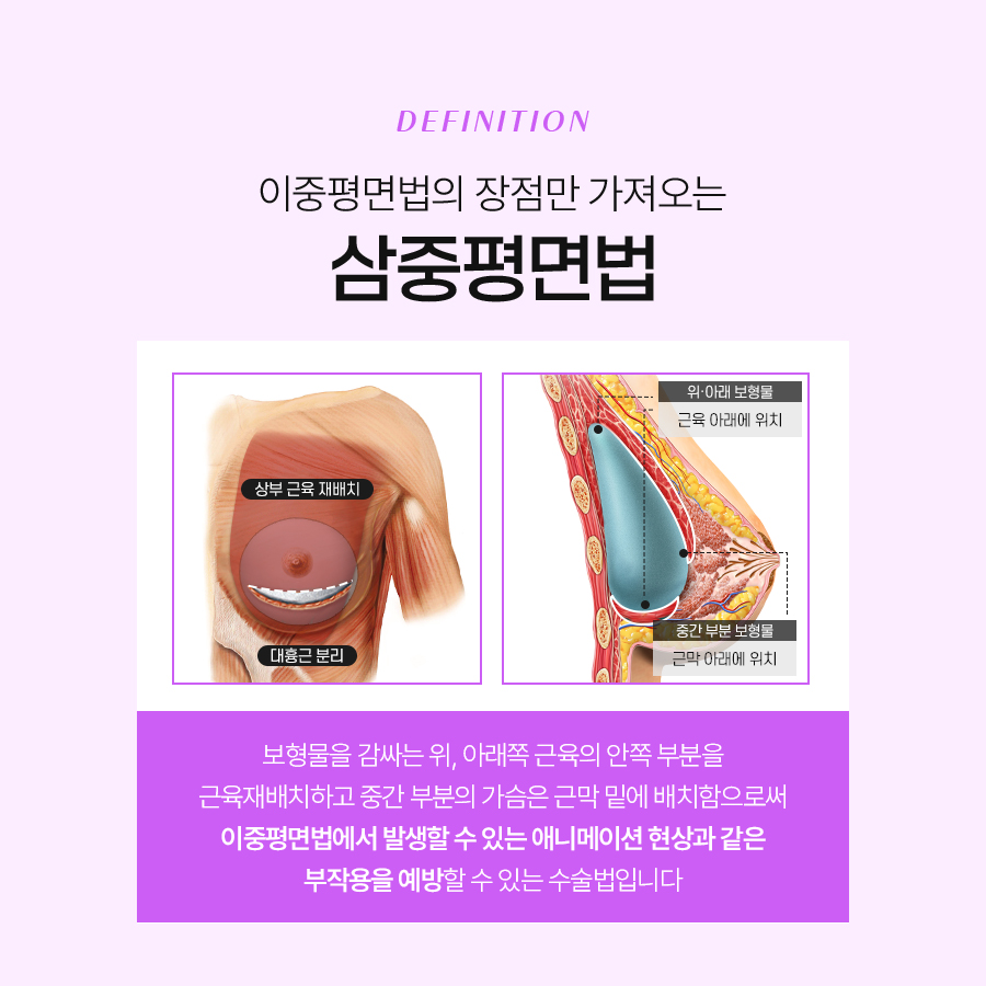 삼중평면법 나에게 맞는 가슴성형 방식일까? 관련 이미지 4