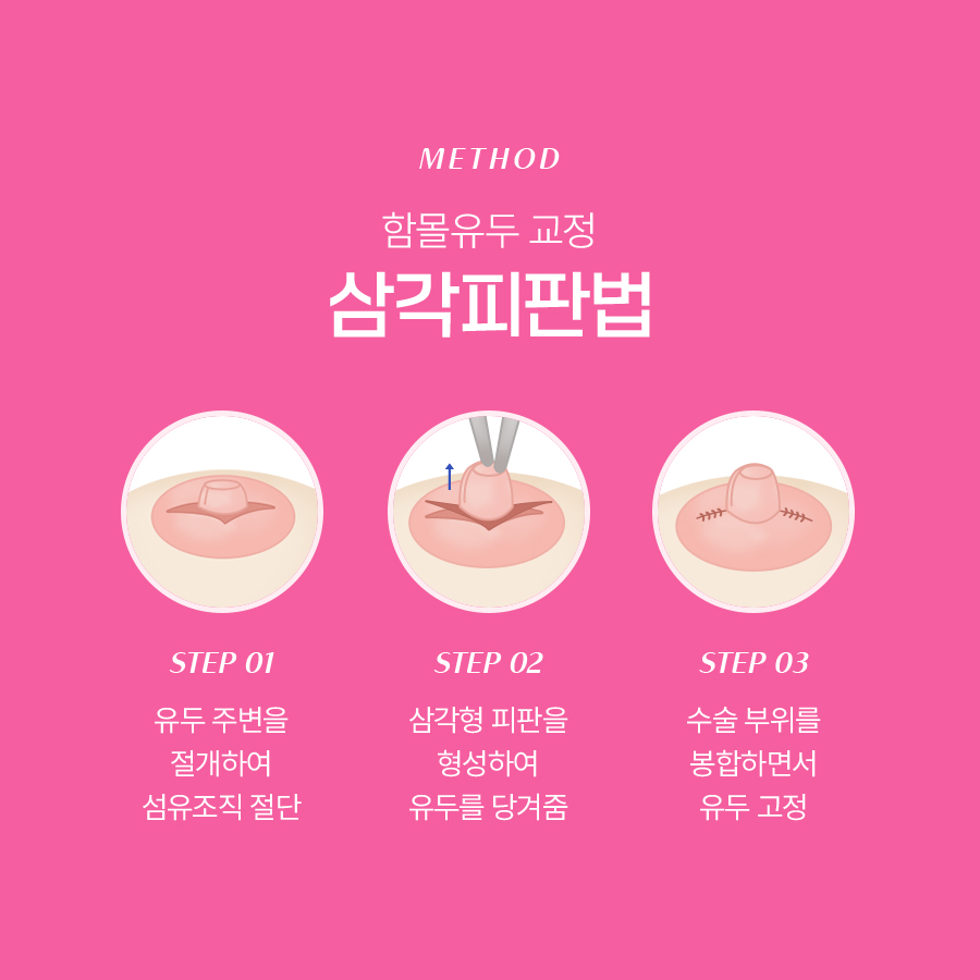 함몰유두 교정법 어떤 원리로 진행될까 관련 이미지 4