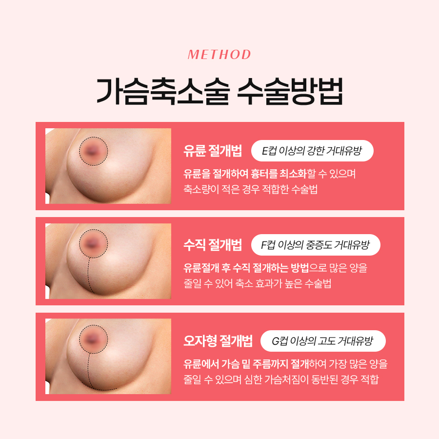 가슴축소성형수술 어떤 기준으로 계획될까? 관련 이미지 5