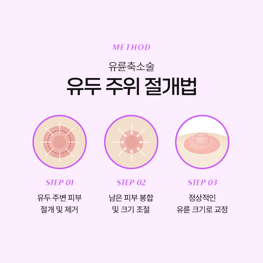 What Is the Areola Reduction Surgery Method, and How Is It Performed? image 4