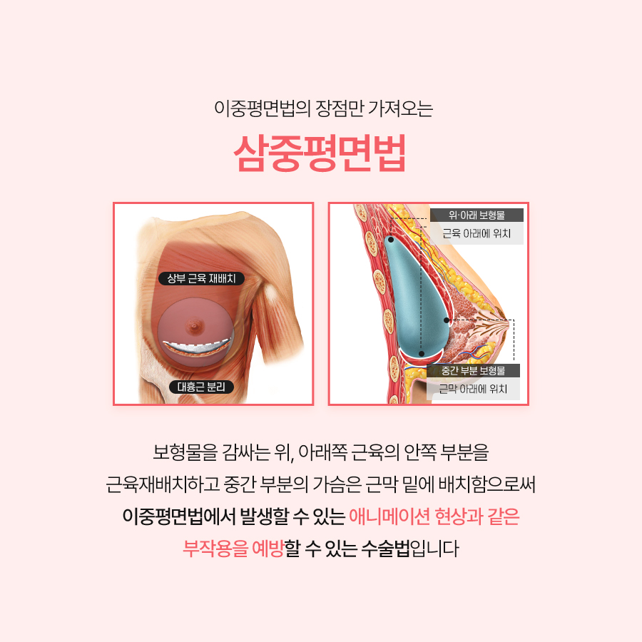 Triple-Plane Breast Augmentation: What Is the Key to Higher Satisfaction? image 4