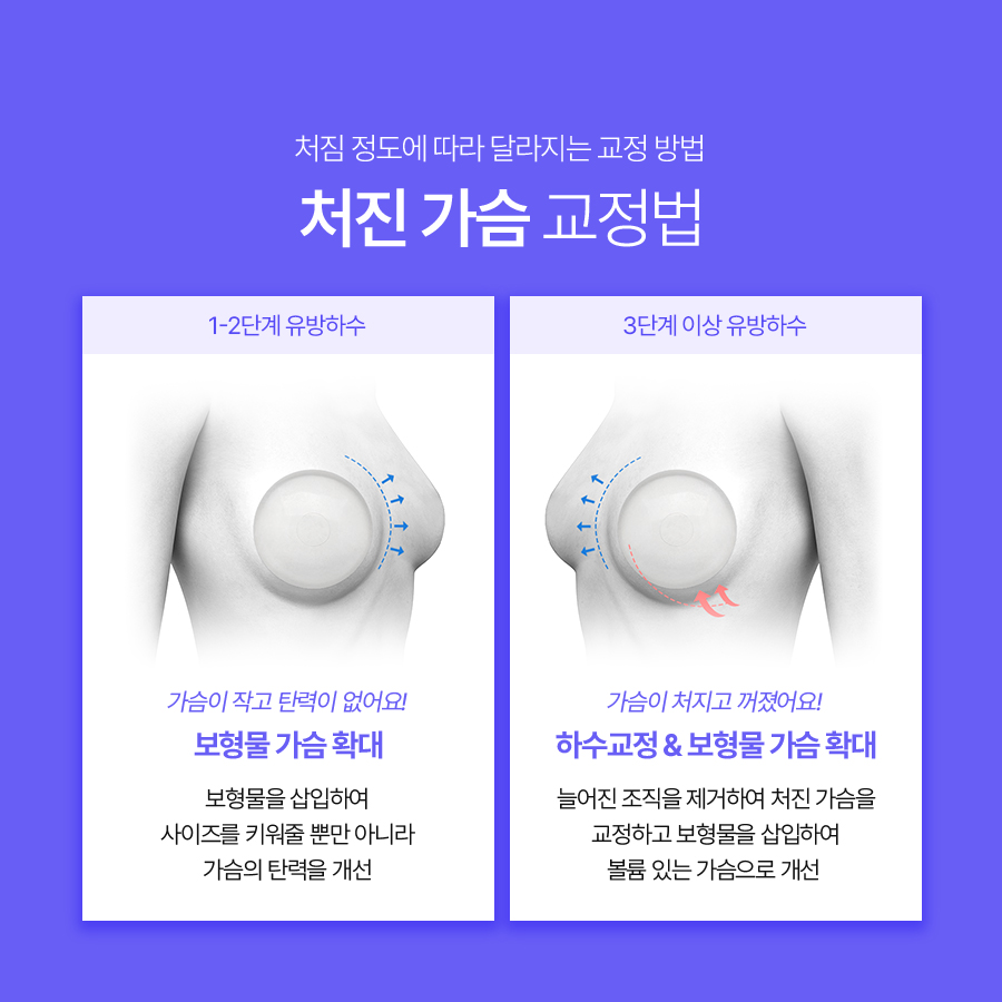 처진가슴수술비용, 처짐 정도에 따른 교정방법 관련 이미지 5