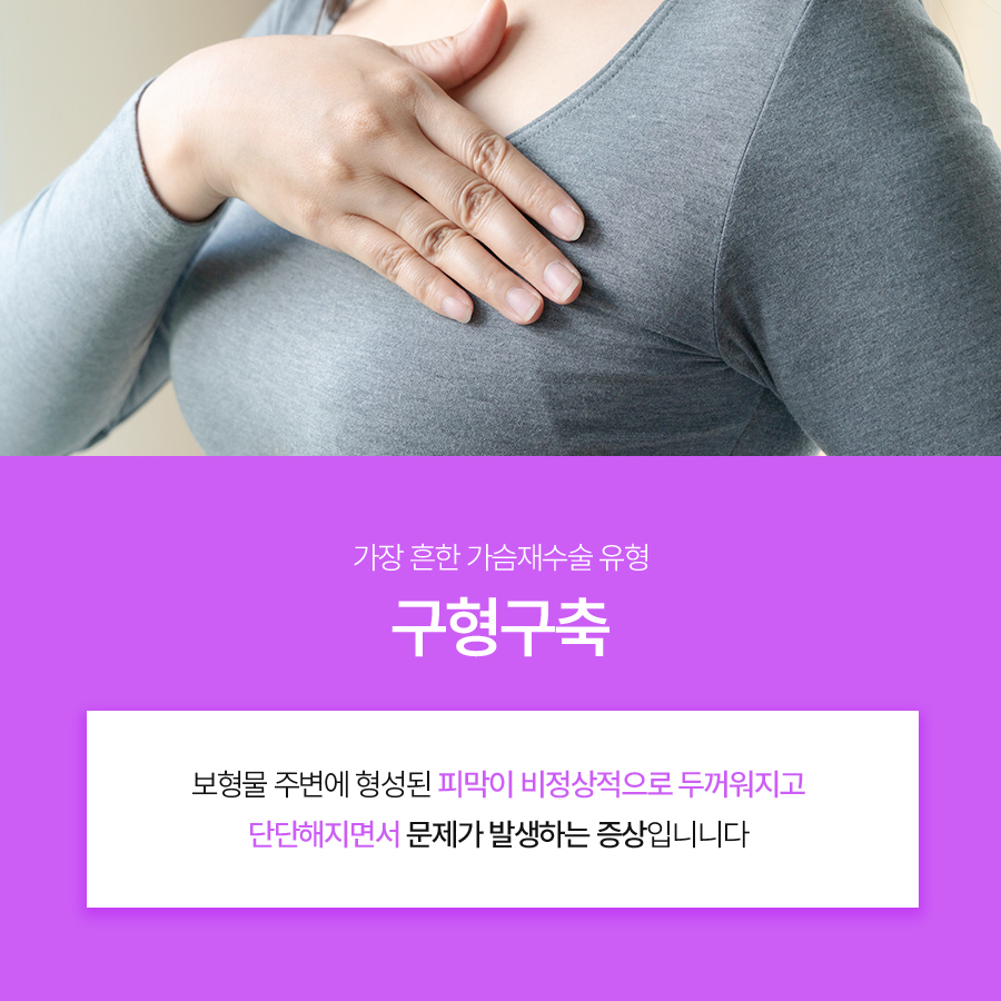 가슴구형구축원인, 가슴재수술 방법 알아보기 관련 이미지 3