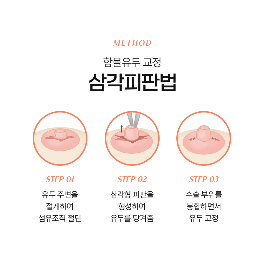 여성함몰유두교정, 원인에 따른 교정 방법 관련 이미지 4