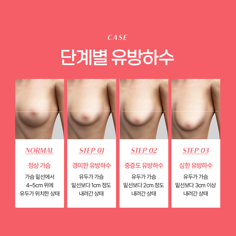 Breast Ptosis Correction Surgery: Restoring Balance to Sagging Breasts image 4
