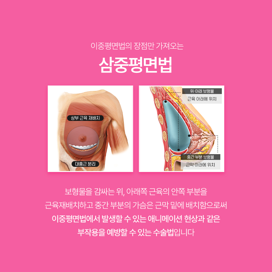 가슴재수술방법, 삼중평면법은 어떤 경우에 고려할까요? 관련 이미지 4