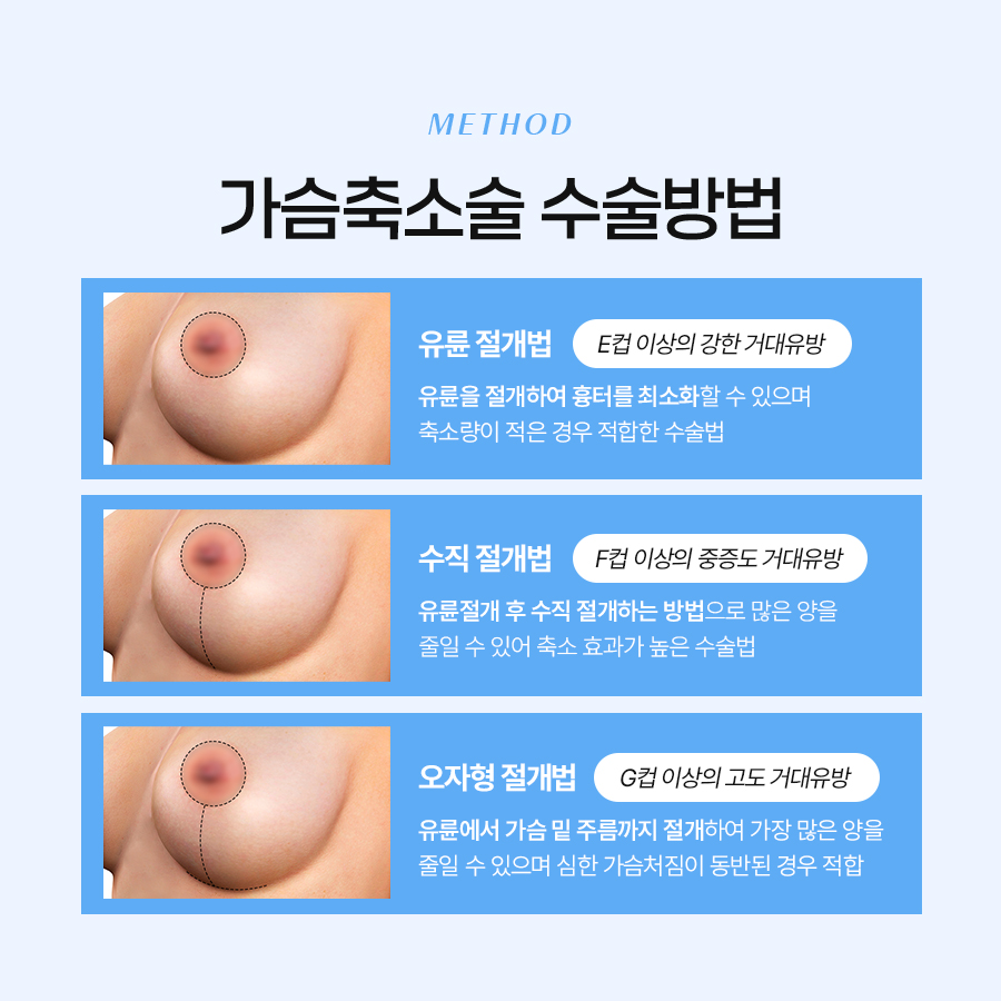 가슴축소수술효과 자연스러운 라인과 건강한 몸을 위한 선택 관련 이미지 4