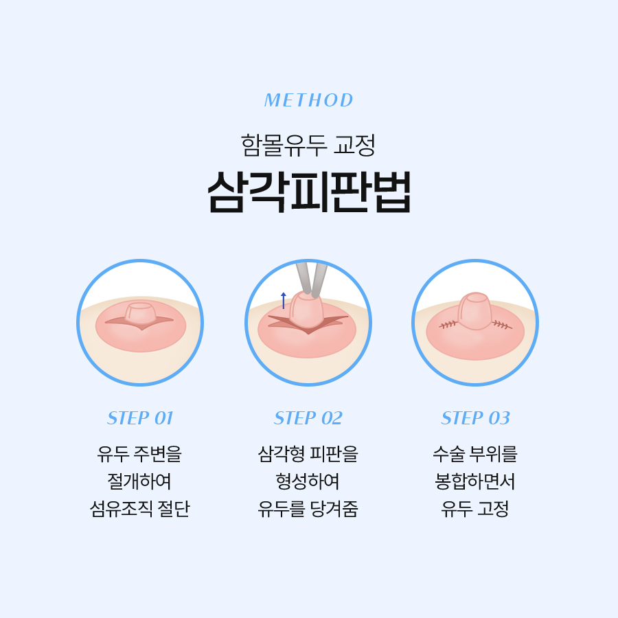 함몰유두교정술, 자신감을 되찾는 첫걸음 관련 이미지 4