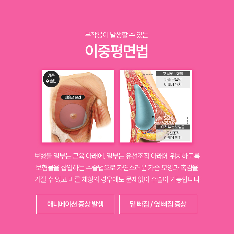 가슴재수술방법, 삼중평면법은 어떤 경우에 고려할까요? 관련 이미지 3