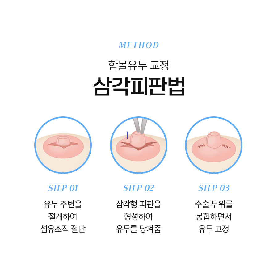 Could the timing of inverted nipple surgery costs also be important? image 4