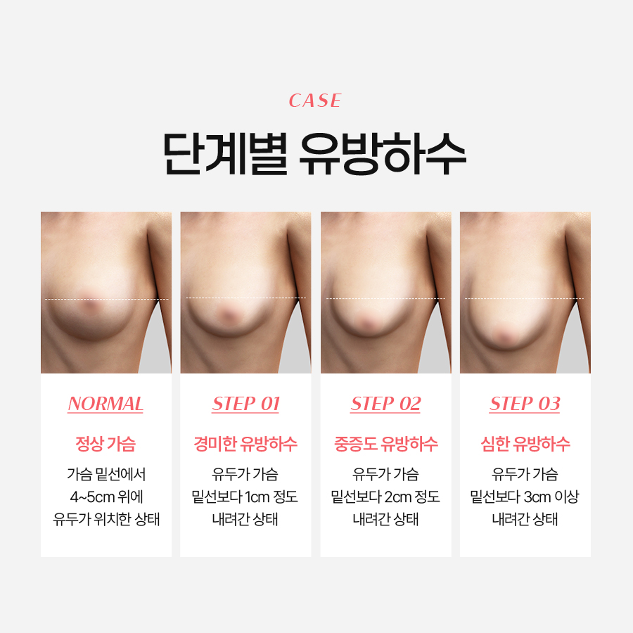 What Should You Consider If You Are Planning Breast Ptosis Surgery? image 4