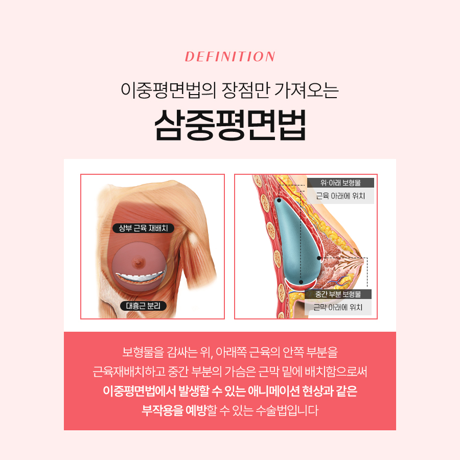 보형물가슴성형 자연스러운 라인 만드는 방법 관련 이미지 4
