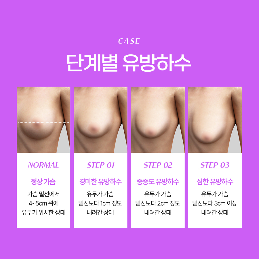 유방하수교정수술 고려 전 가슴 변화 원리 정리 관련 이미지 4
