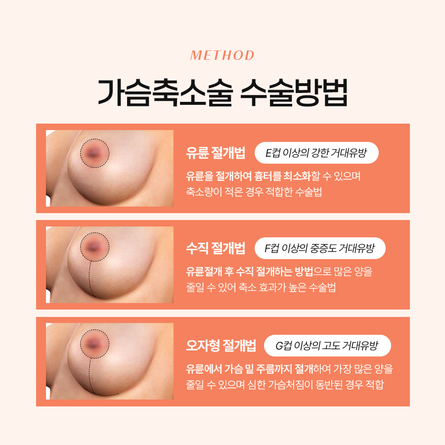 The Benefits of Breast Reduction Surgery: A Choice for Easier Movement image 6