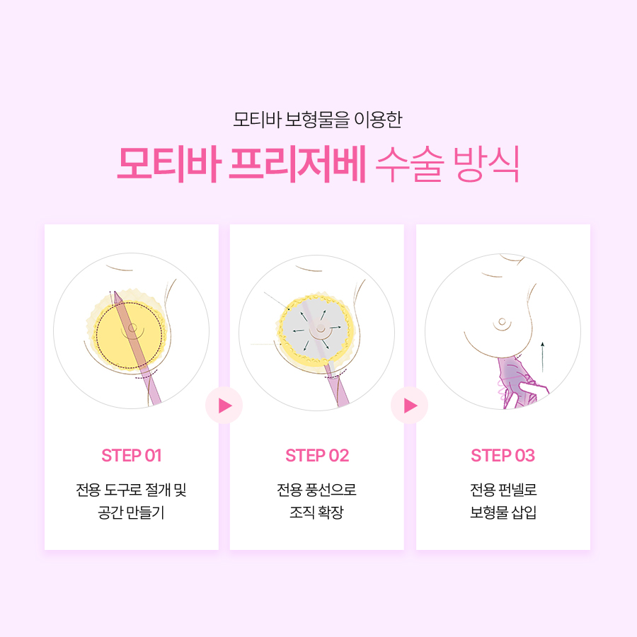 모티바 프리저베 성형외과, 기존 가슴성형과 무엇이 다를까요? 관련 이미지 4
