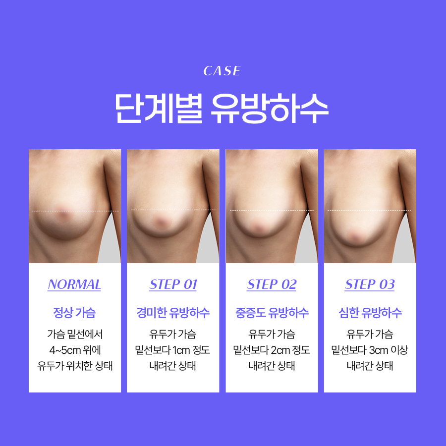 유방하수교정술 가슴 라인 회복을 위한 선택 관련 이미지 4
