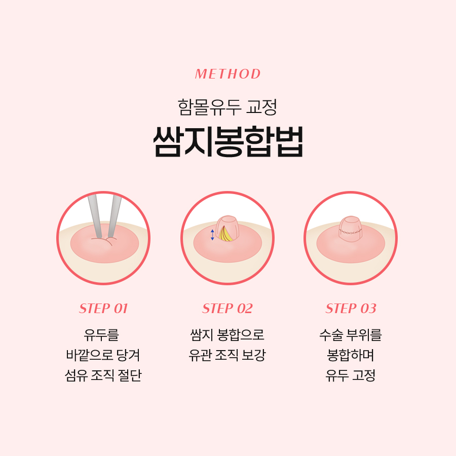 함몰유두교정방법 기능과 미용을 동시에 개선하는 솔루션 관련 이미지 5