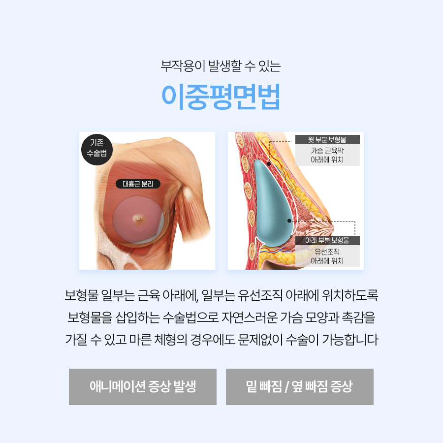Three-Plane Breast Augmentation: Natural-Looking Breasts Begin with Planning image 3