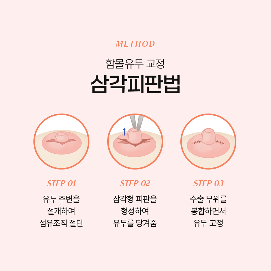 함몰유두 교정법, 어떤 수술이 나에게 맞을까? 관련 이미지 5