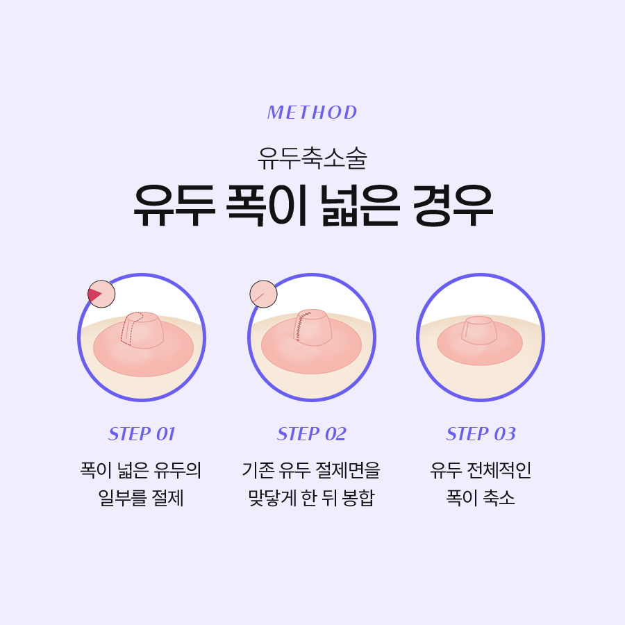 가슴유두축소술 매력적인 변화로 자신감을 높이는 선택 관련 이미지 4
