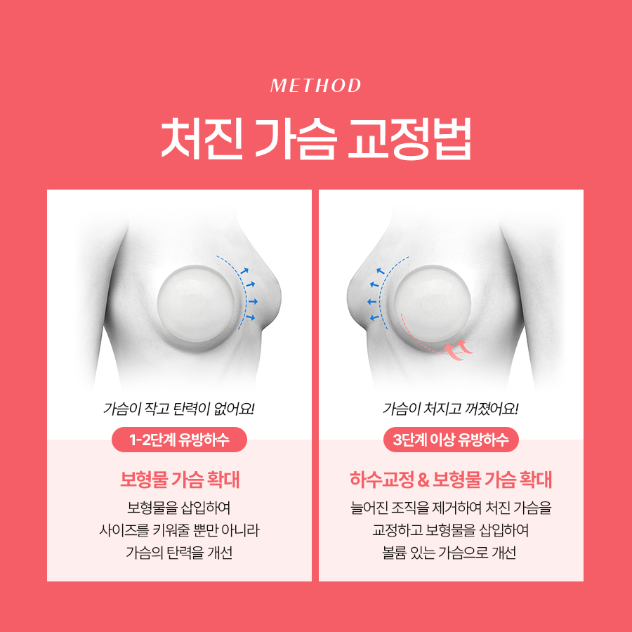 Breast Ptosis Correction Surgery: Restoring Balance to Sagging Breasts image 5