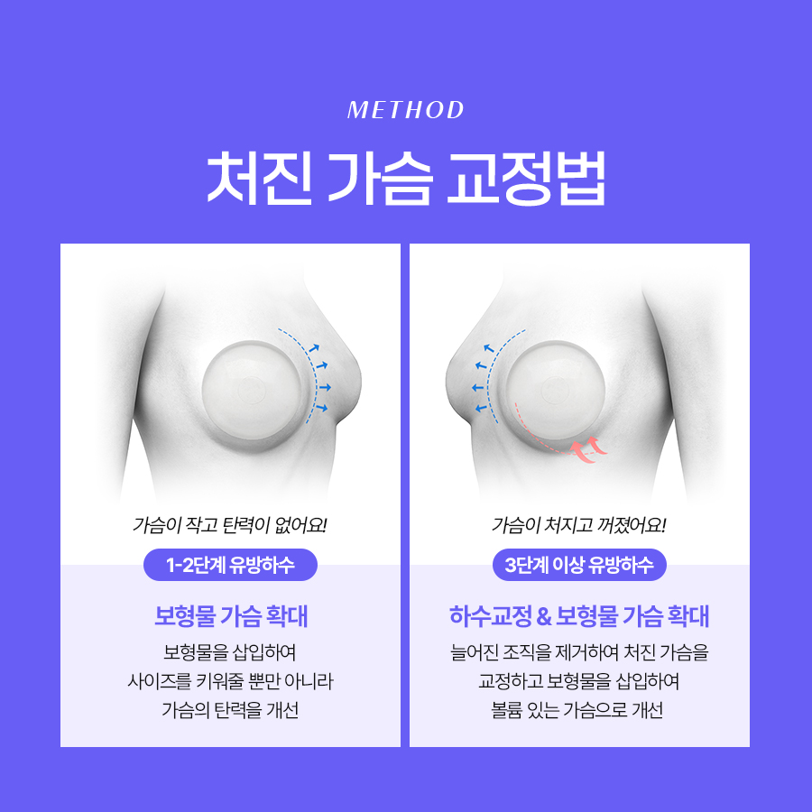유방하수교정술 가슴 라인 회복을 위한 선택 관련 이미지 5
