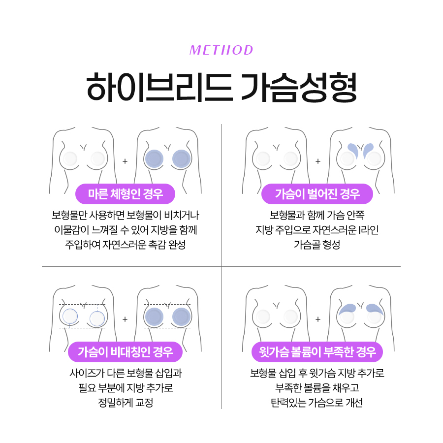 하이브리드 가슴성형 개인별 맞춤형 수술을 위한 관련 이미지 6