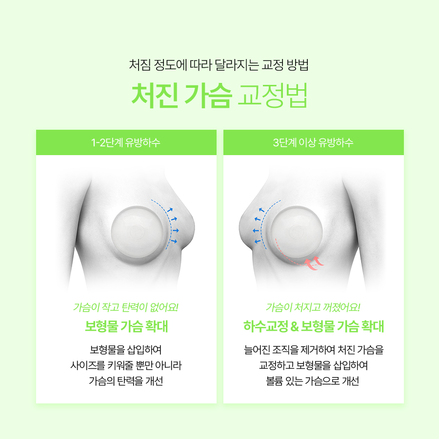 유방하수교정수술, 처짐 고민 해결하고 볼륨 중심 이동 관련 이미지 5