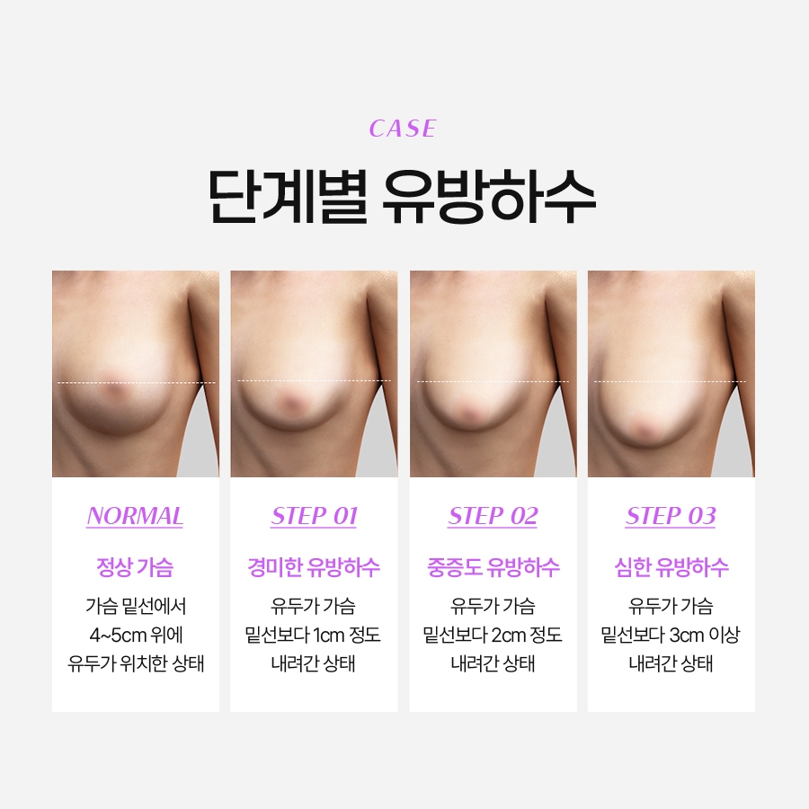 중년처진가슴수술 자신감을 되찾는 방법 관련 이미지 4
