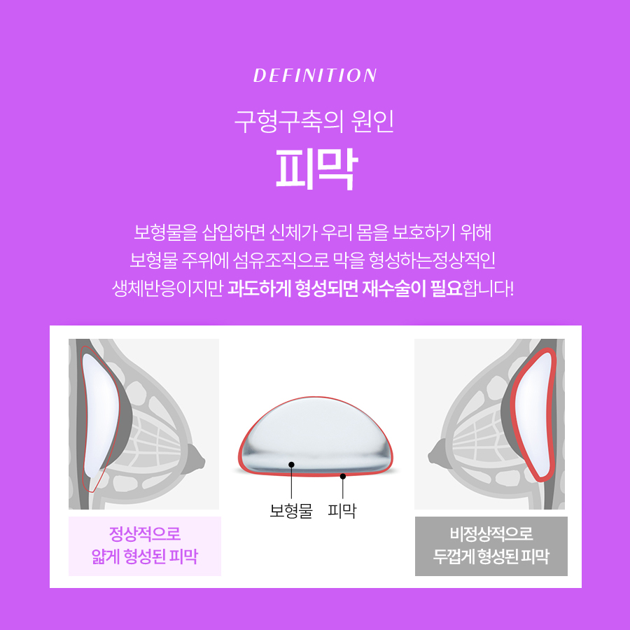 가슴재수술 겨드랑이절개 흉터 부담 없는 수술 선택 관련 이미지 3
