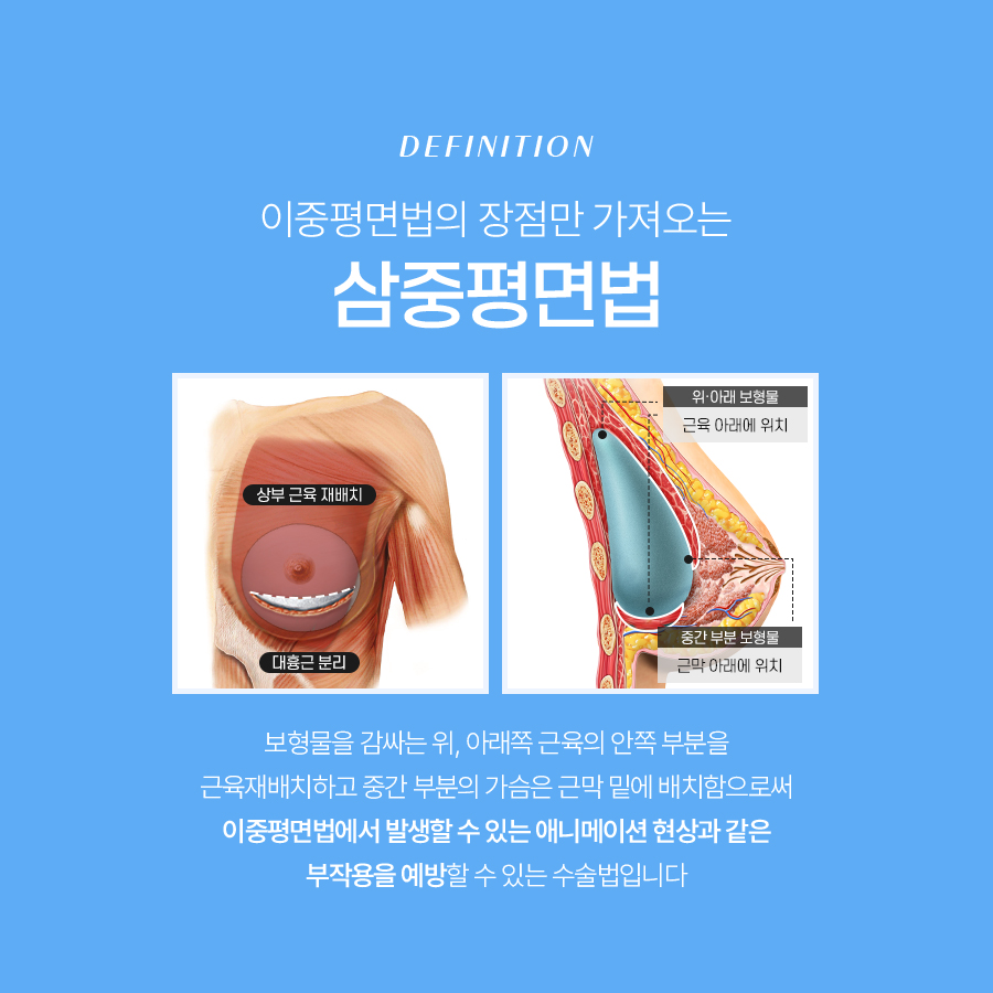 가슴성형겨절흉터 최소화하는 방법 관련 이미지 4