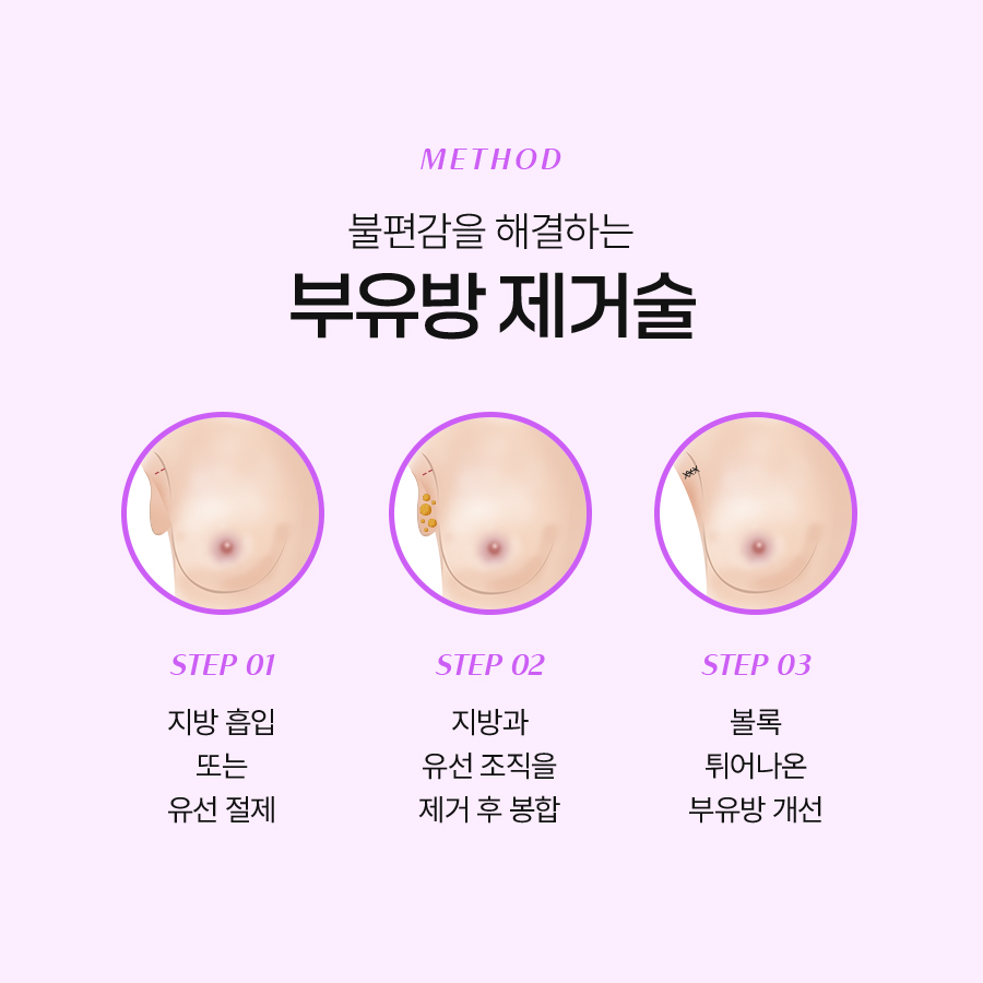 부유방제거수술 흉터 부유방이 생기는 이유 정리 관련 이미지 5