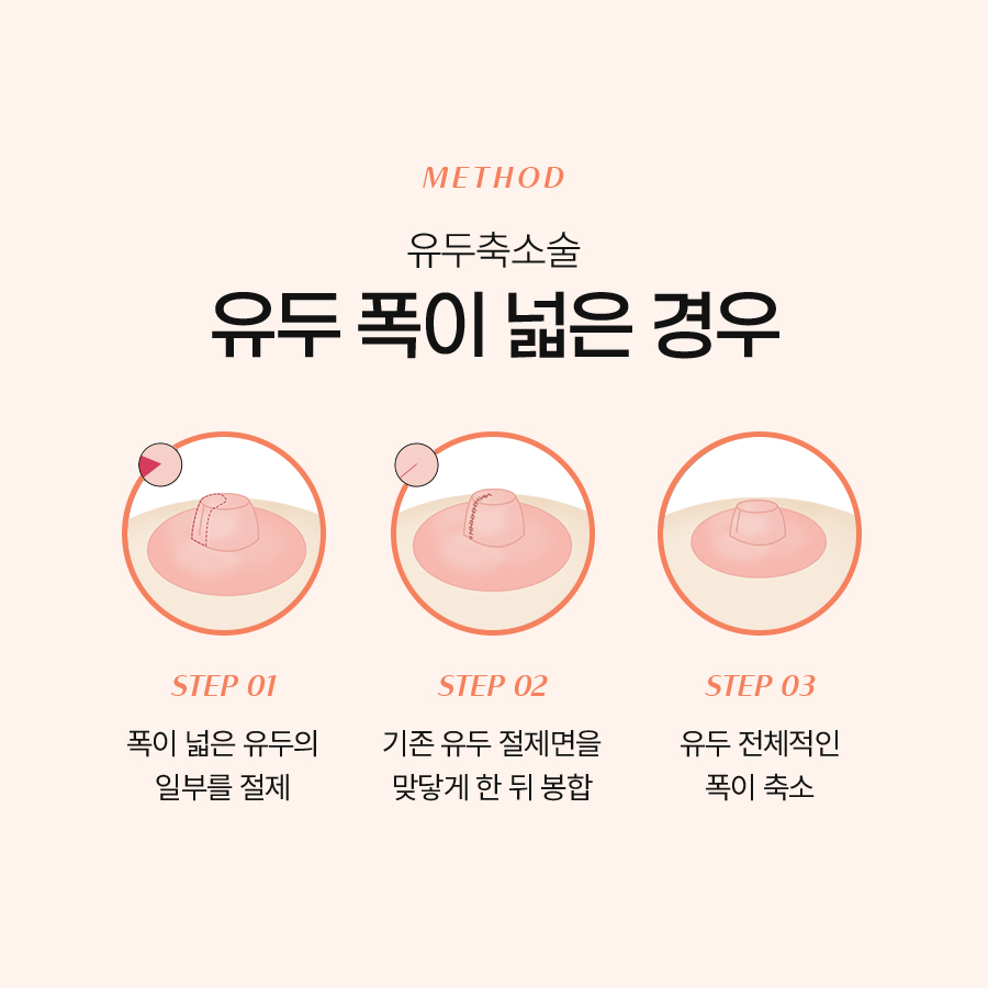 가슴유두축소수술 후 기대할 수 있는 변화 관련 이미지 5