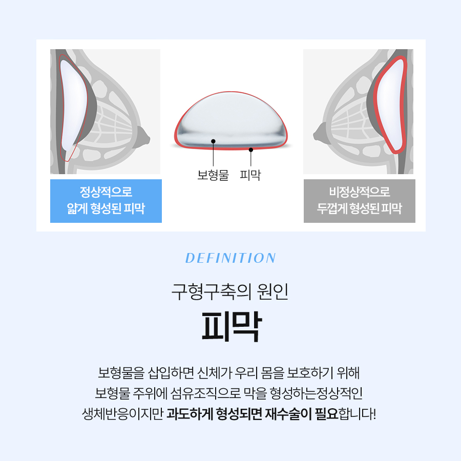 구형구축피막제거 재수술, 요즘은 이렇게 달라졌다 관련 이미지 5