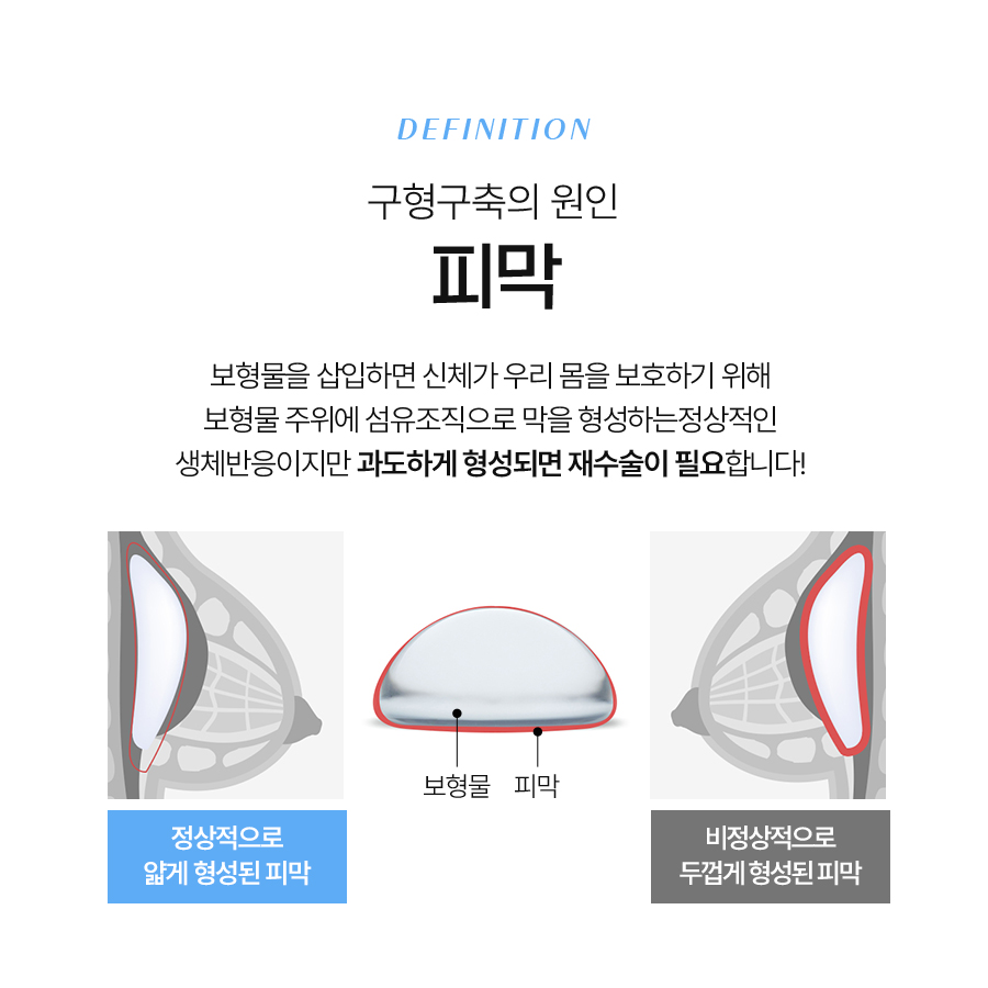 가슴구형구축 재수술 전 반드시 확인해야 할 모든 것 관련 이미지 4