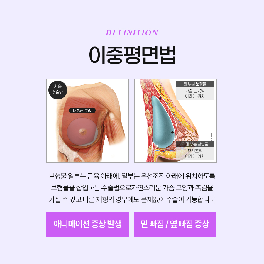 삼중평면법 나에게 맞는 가슴성형 방식일까? 관련 이미지 3