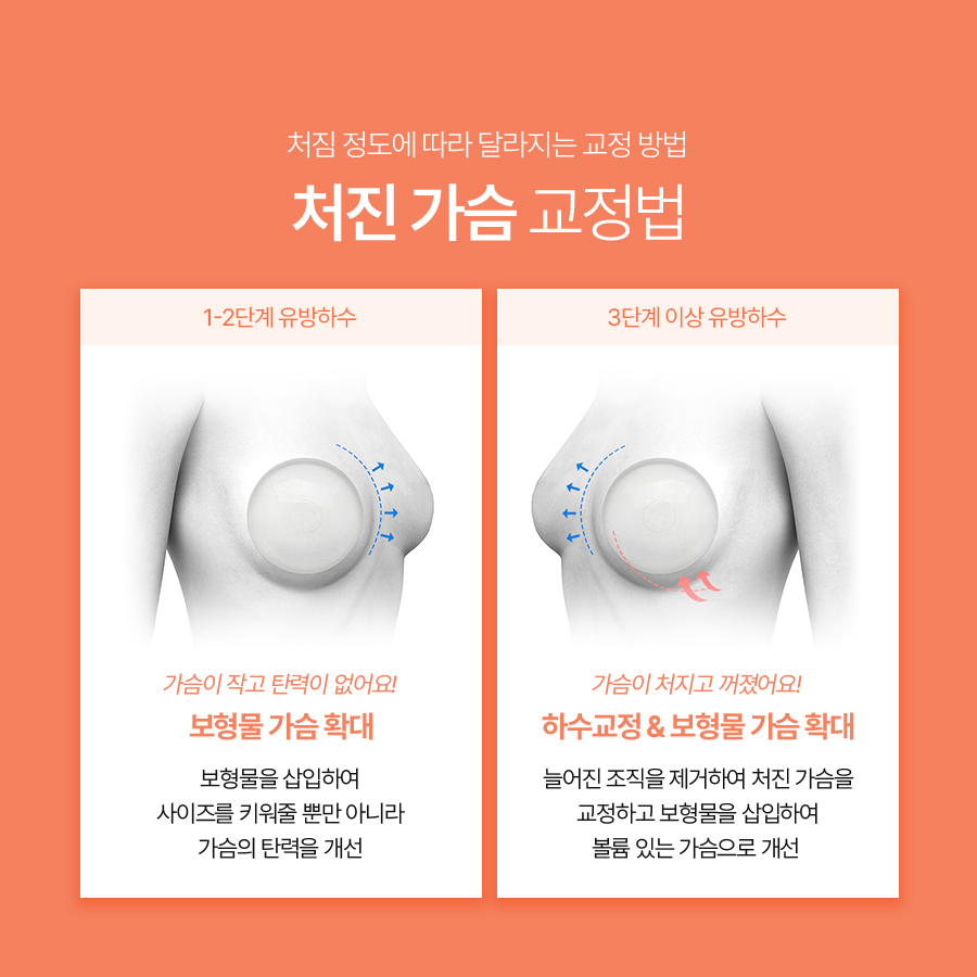 유방하수교정수술, 보형물만으로 해결되지 않는 가슴 처짐 관련 이미지 5