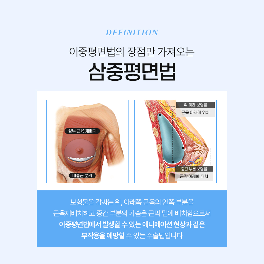 가슴 볼륨 수술 나에게 맞는 방법과 종류 총정리 관련 이미지 5