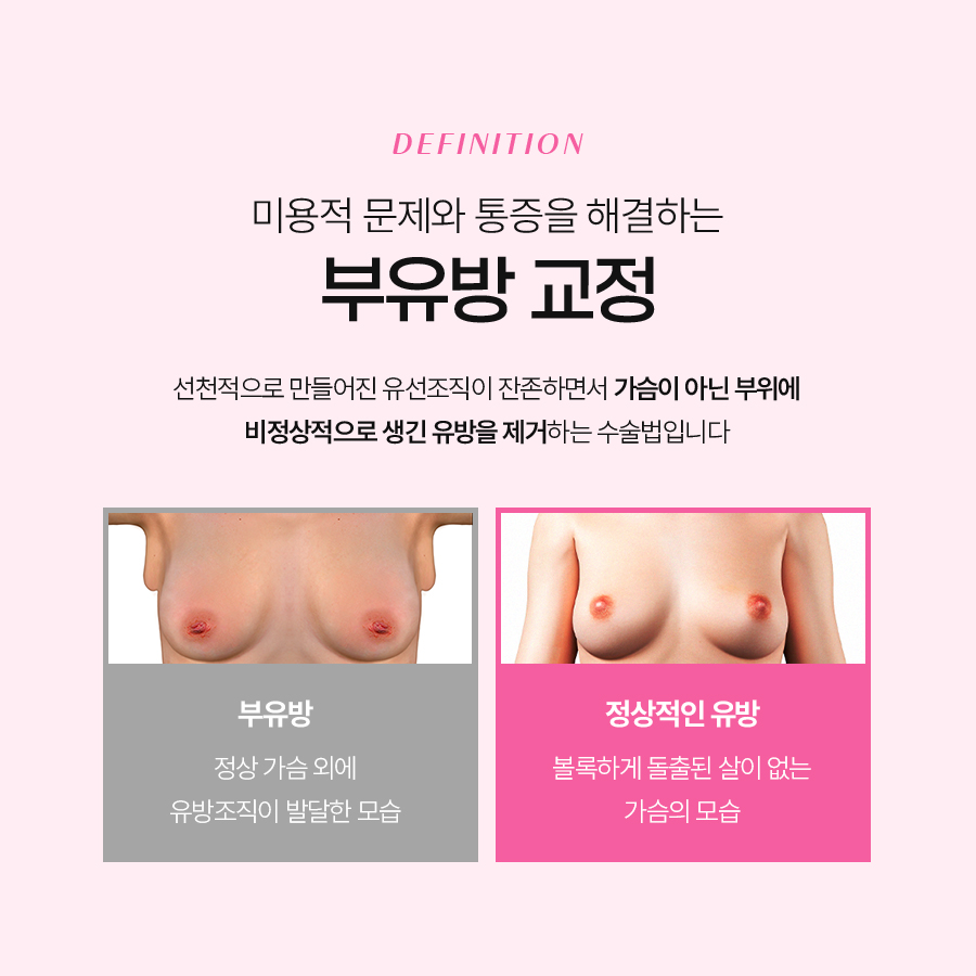 How Axillary Accessory Breast Correction Surgery Creates a Smooth Side Line image 4