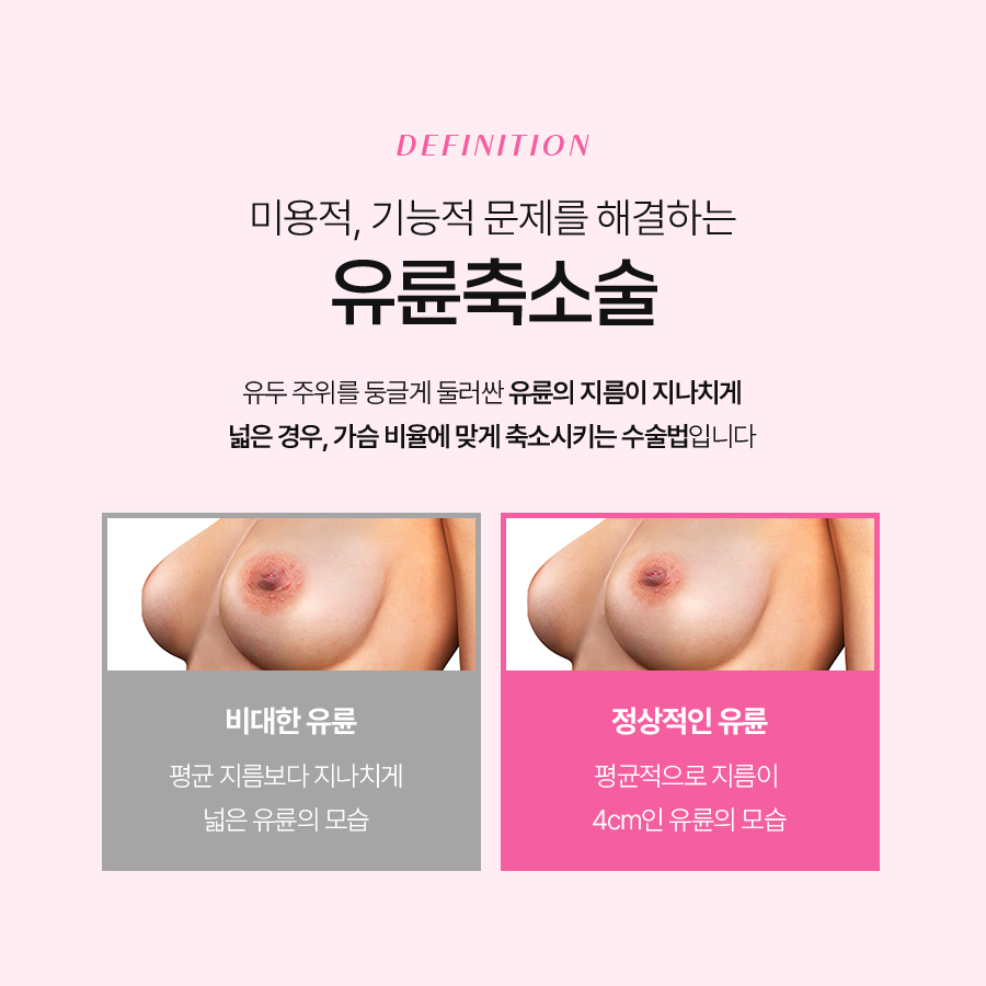 유륜축소수술방법 변화가 시작되는 기준은 무엇일까 관련 이미지 3